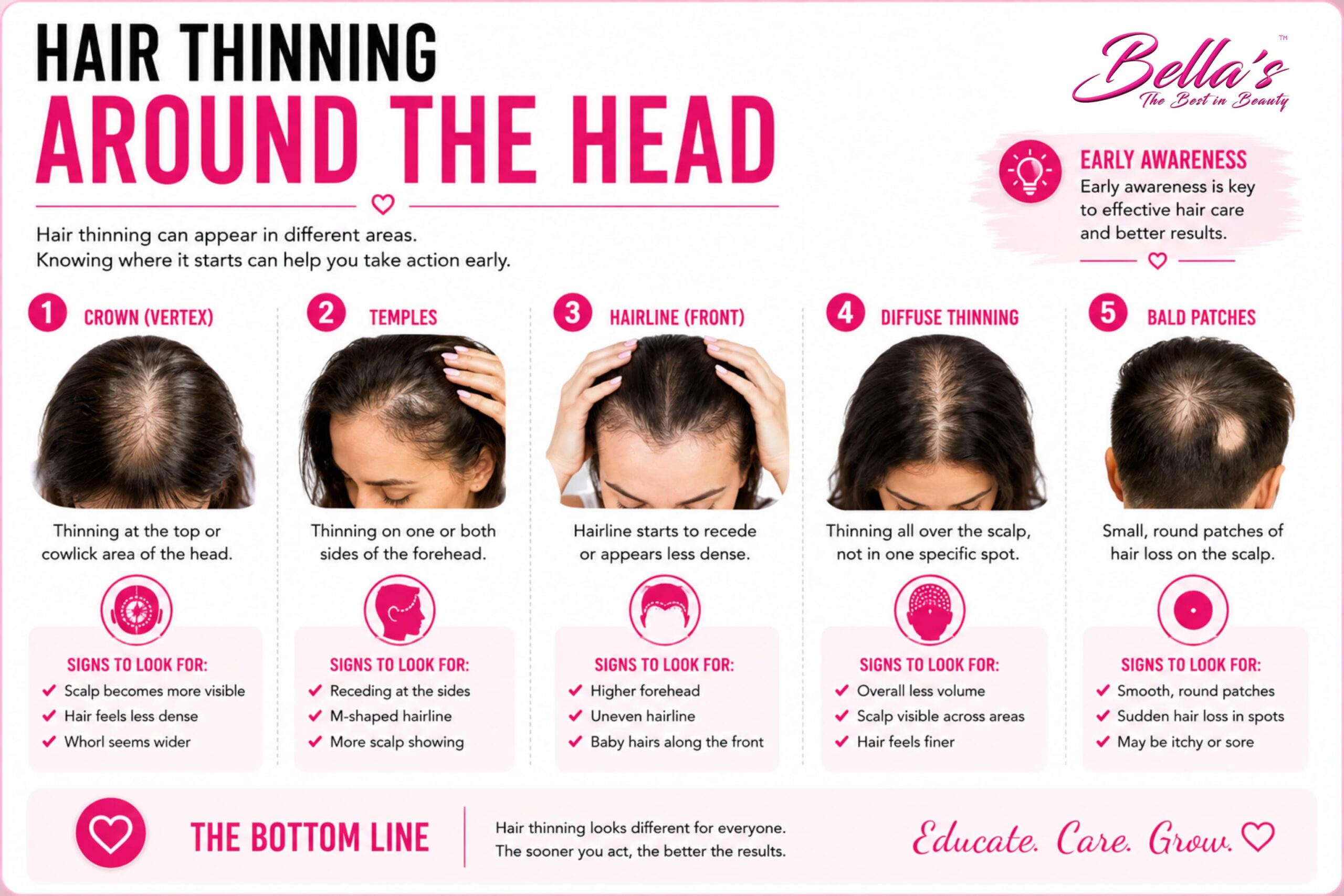 Infographic showing common hair thinning patterns including the crown, temples, hairline, diffuse thinning and bald patches.